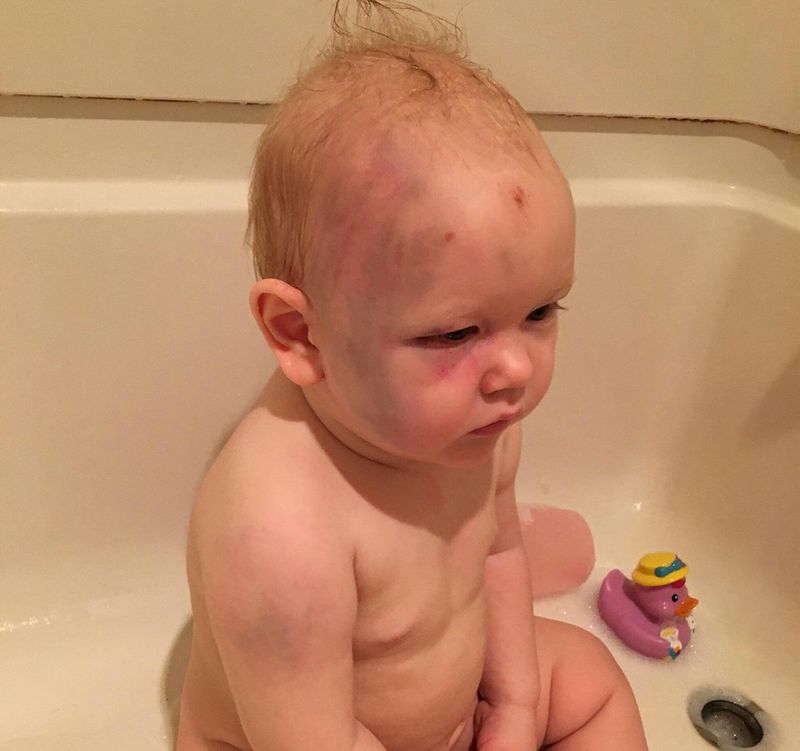 Injured toddler Jacob Marbury (Photo: Facebook / Joshua Marbury)